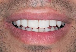 Rex Baumgartner, DDS | Cosmetic Dentistry, Crowns  amp  Caps and Implant Dentistry