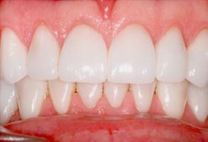 Rex Baumgartner, DDS | Full Mouth Reconstruction, Veneers and Dentures