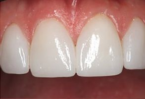 Rex Baumgartner, DDS | CEREC reg , Cosmetic Dentistry and Teeth Whitening