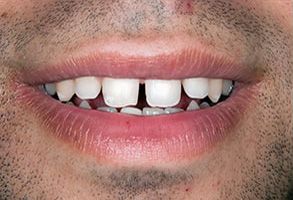 Rex Baumgartner, DDS | CEREC reg , Teeth Whitening and Preventative Program